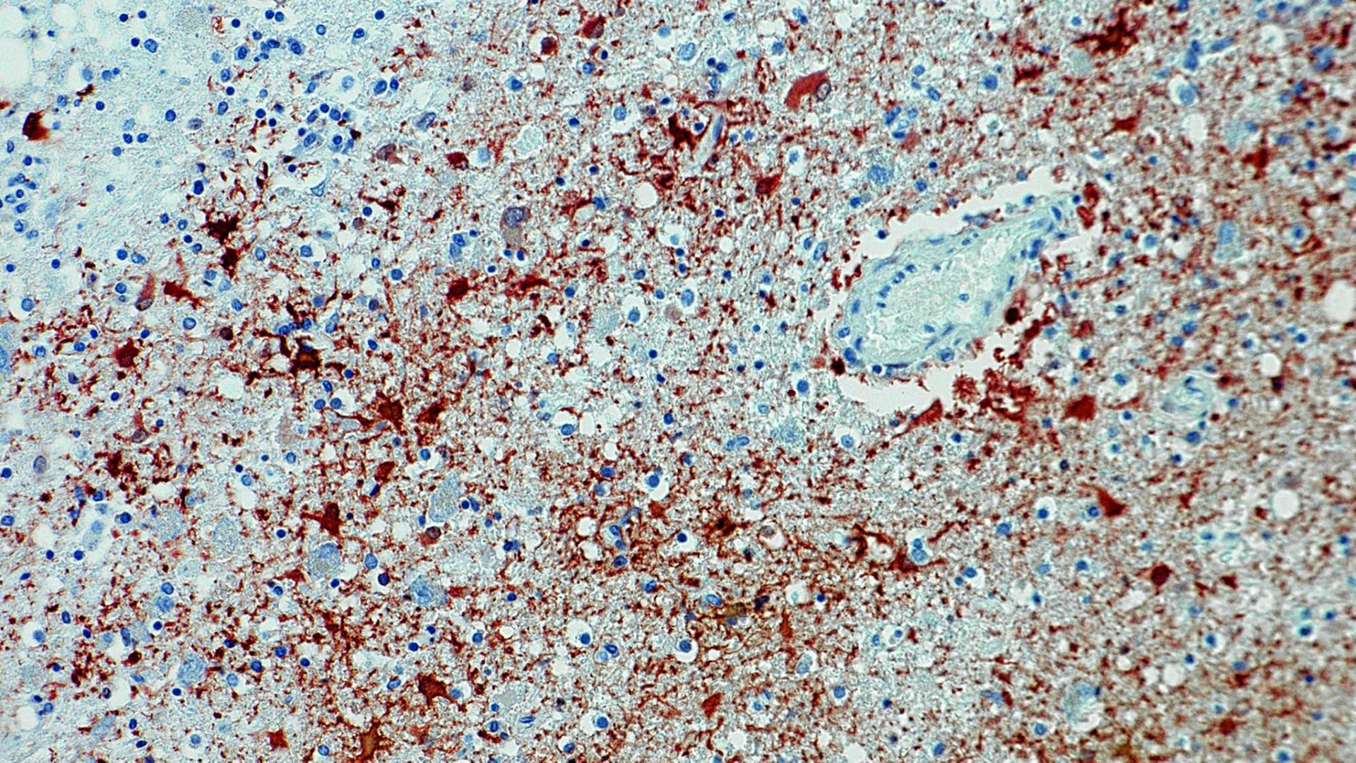 Die undatierte Aufnahme zeigt einen Antikörpernachweis zum Borna-Virus im Gewebe. Lange war die Borna-Krankheit nur von Nutztieren bekannt. Nun bestätigen neue Nachweise: Auch beim Menschen sorgt das Virus in Deutschland für Todesfälle. Die undatierte Aufnahme zeigt einen Antikörpernachweis zum Borna-Virus im Gewebe. Lange war die Borna-Krankheit nur von Nutztieren bekannt. Nun bestätigen neue Nachweise: Auch beim Menschen sorgt das Virus in Deutschland für Todesfälle.