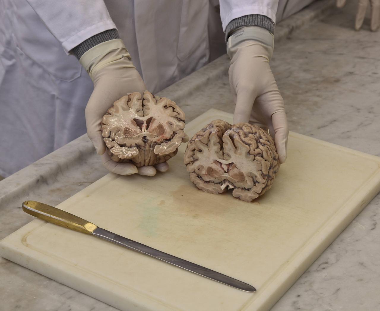 Schnitt durch das Gehirn eines verstorbenen Alzheimer-Patienten an der Berliner Charité
