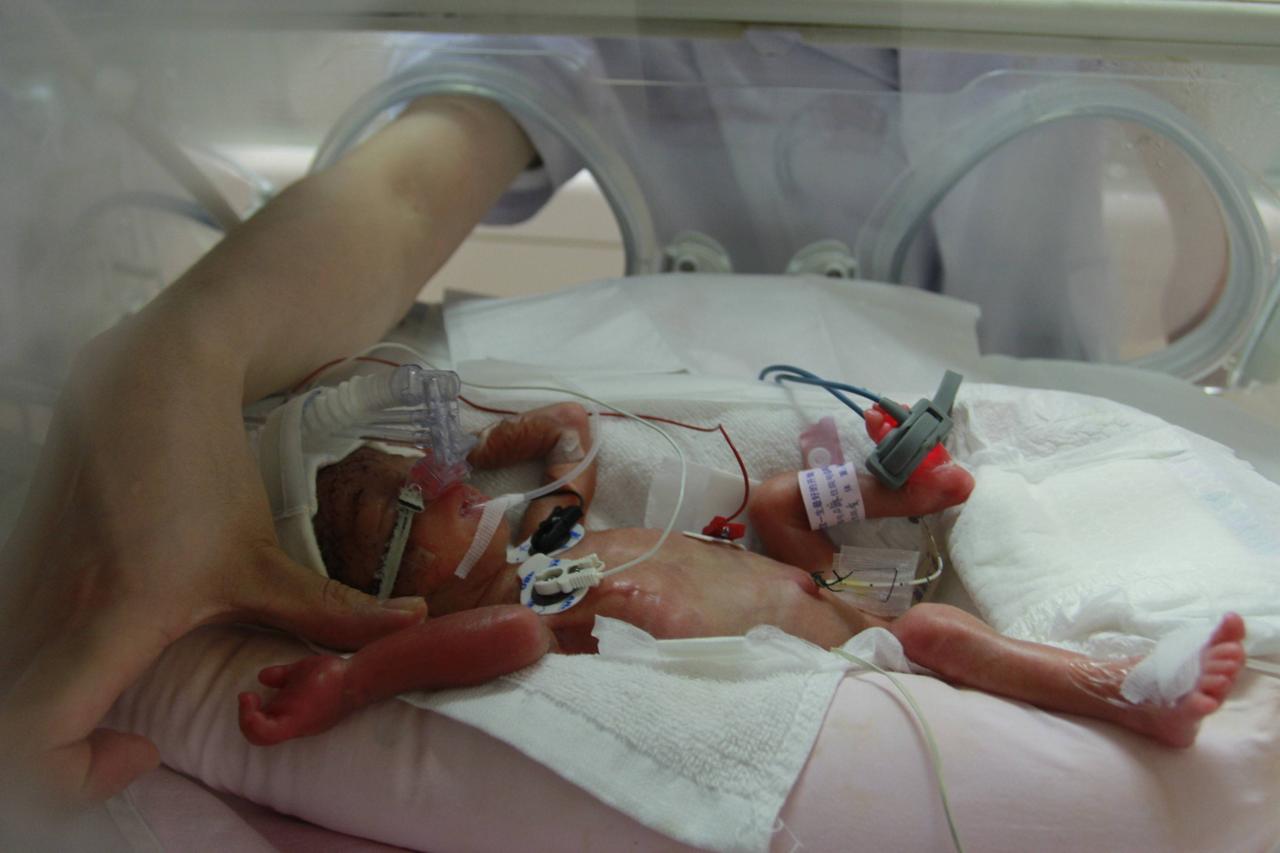 Ein Frühgeborenes mit 680 Gramm Geburtsgewicht im Brutkasten im Xiangya Hospital, China  (30.10.2013)